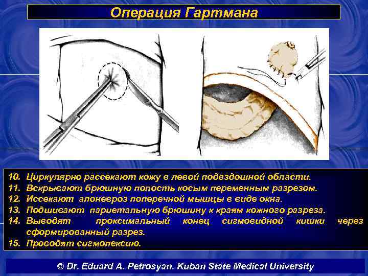 Операция Гартмана 10. 11. 12. 13. 14. Циркулярно рассекают кожу в левой подвздошной области.