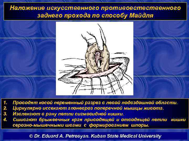 Наложение искусственного противоестественного заднего прохода по способу Майдля 1. 2. 3. 4. Проводят косой