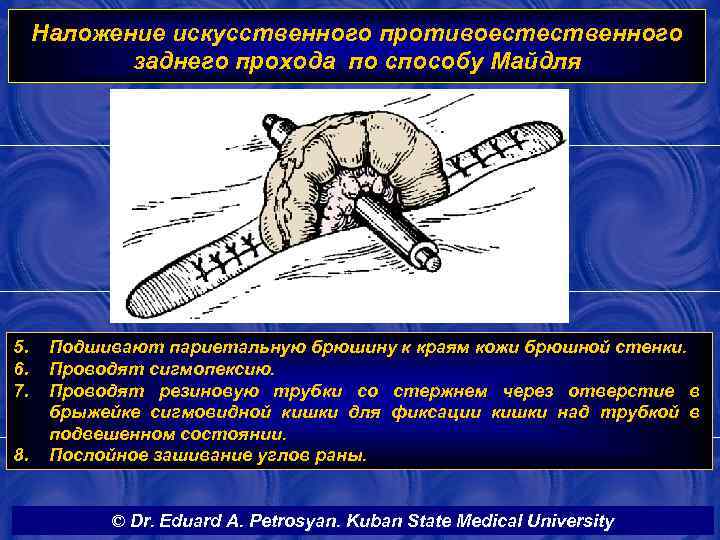 Наложение искусственного противоестественного заднего прохода по способу Майдля 5. 6. 7. 8. Подшивают париетальную