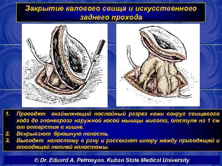 Закрытие калового свища и искусственного заднего прохода 1. 2. 3. Проводят окаймляющий послойный разрез