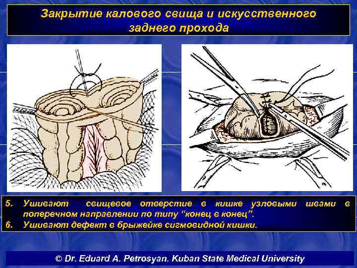 Закрытие калового свища и искусственного заднего прохода 5. 6. Ушивают свищевое отверстие в кишке