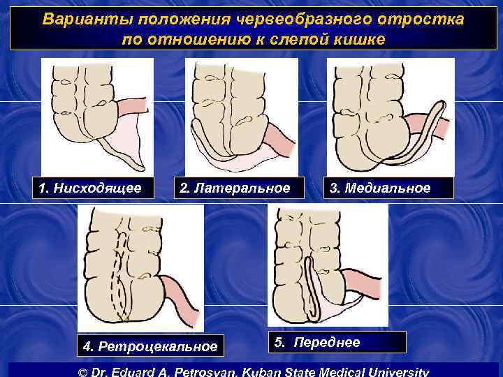 Варианты положения червеобразного отростка по отношению к слепой кишке 1. Нисходящее 2. Латеральное 4.