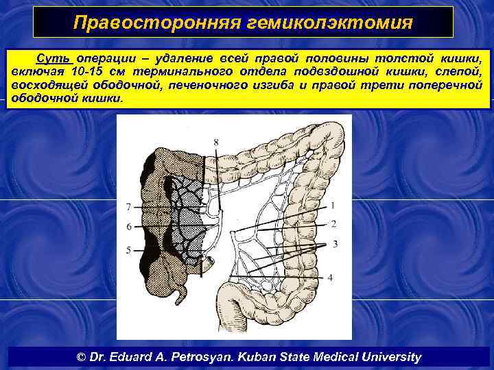 Правосторонняя гемиколэктомия Cуть операции – удаление всей правой половины толстой кишки, включая 10 -15