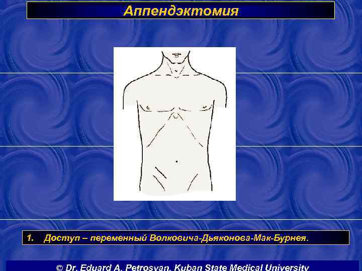 Аппендэктомия 1. Доступ – переменный Волковича-Дьяконова-Мак-Бурнея. © Dr. Eduard A. Petrosyan. Kuban State Medical