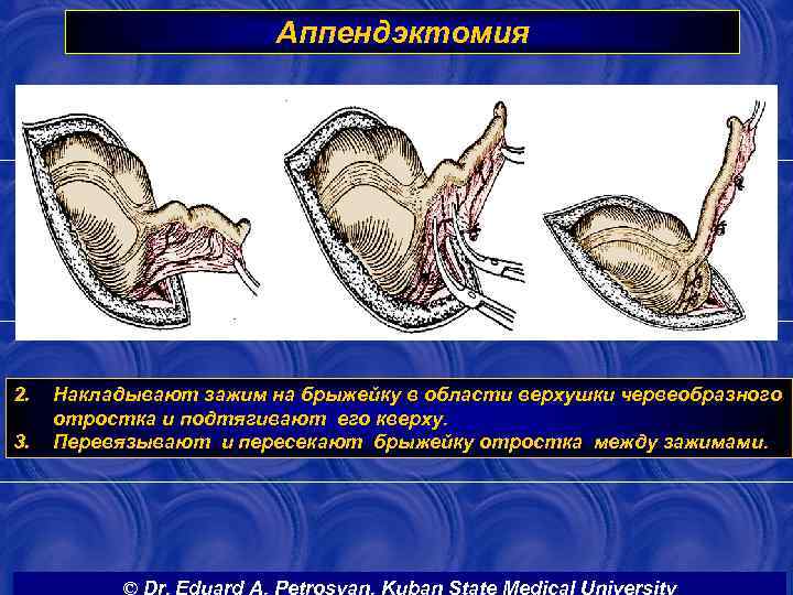 Аппендэктомия 2. 3. Накладывают зажим на брыжейку в области верхушки червеобразного отростка и подтягивают