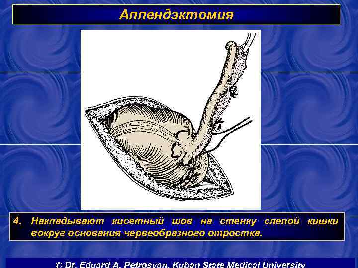 Аппендэктомия 4. Накладывают кисетный шов на стенку слепой кишки вокруг основания червеобразного отростка. ©