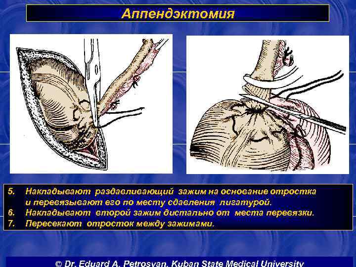 Аппендэктомия 5. 6. 7. Накладывают раздавливающий зажим на основание отростка и перевязывают его по