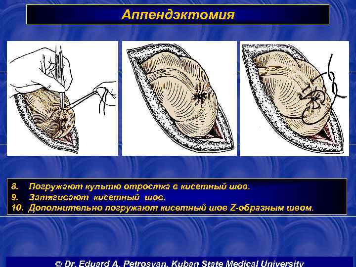 Аппендэктомия 8. Погружают культю отростка в кисетный шов. 9. Затягивают кисетный шов. 10. Дополнительно