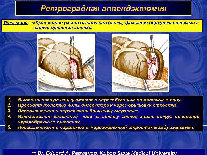 Ретроградная аппендэктомия Показания: забрюшинное расположение отростка, фиксация верхушки спайками к задней брюшной стенке. 1.