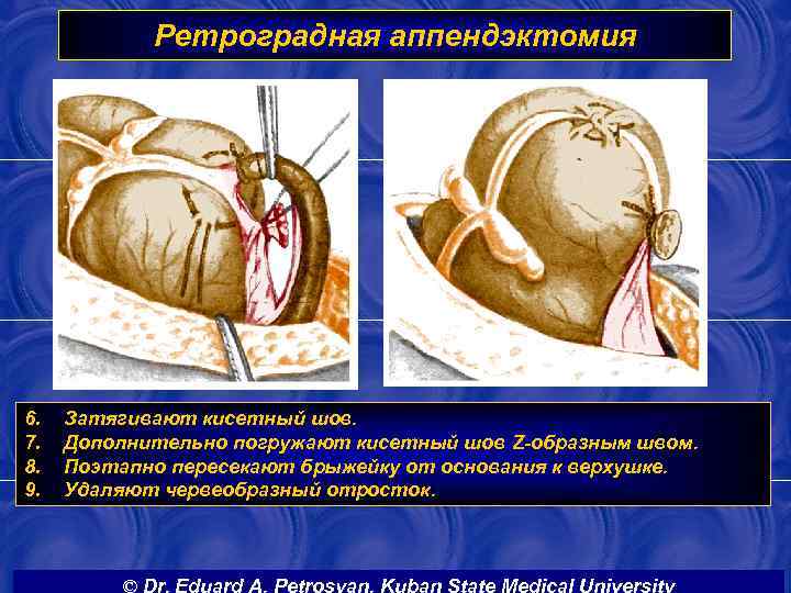 Ретроградная аппендэктомия 6. 7. 8. 9. Затягивают кисетный шов. Дополнительно погружают кисетный шов Z-образным