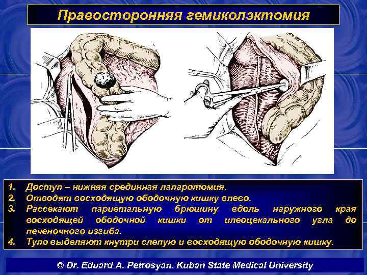 Правосторонняя гемиколэктомия 1. 2. 3. 4. Доступ – нижняя срединная лапаротомия. Отводят восходящую ободочную