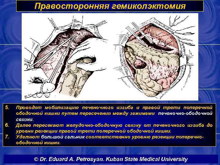 Правосторонняя гемиколэктомия 5. 6. 7. Проводят мобилизацию печеночного изгиба и правой трети поперечной ободочной