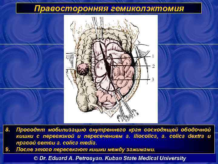 Правосторонняя гемиколэктомия 8. 9. Проводят мобилизацию внутреннего края восходящей ободочной кишки с перевязкой и