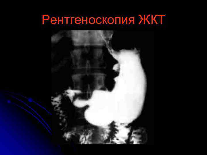 Рентгеноскопия ЖКТ 