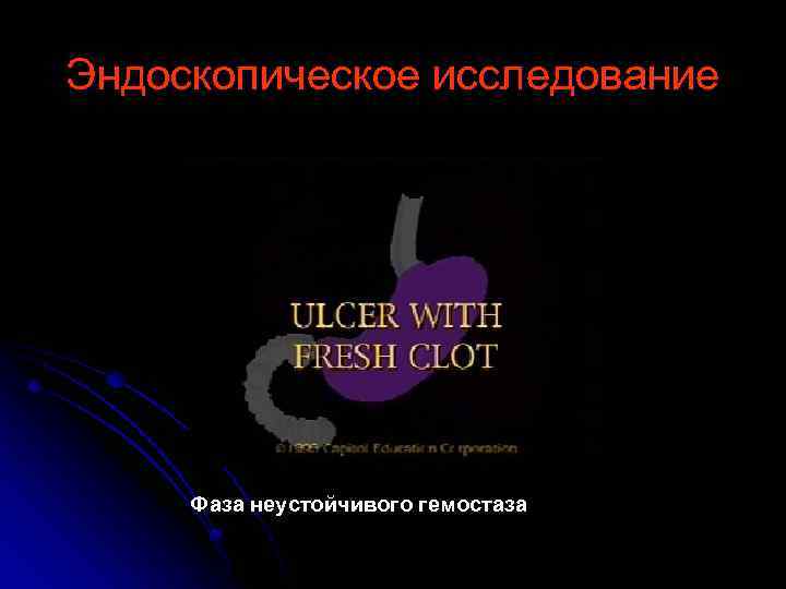 Эндоскопическое исследование Фаза неустойчивого гемостаза 
