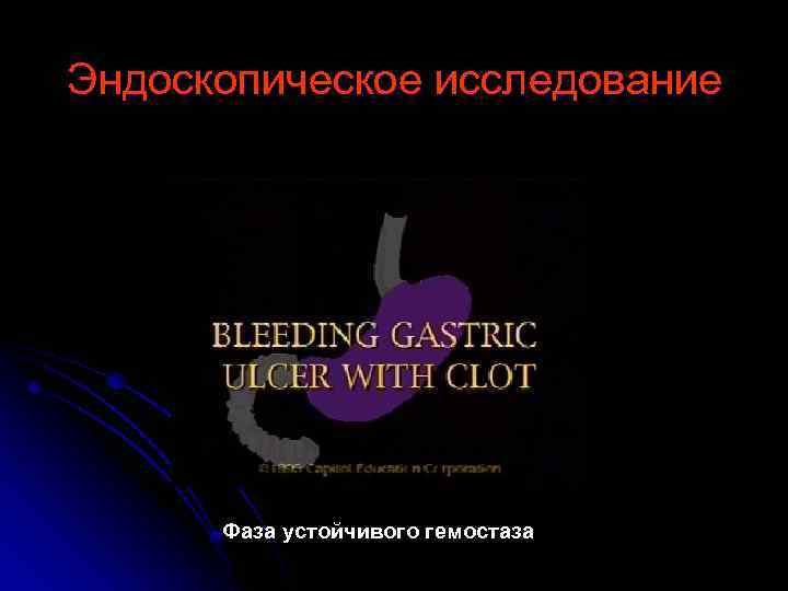 Эндоскопическое исследование Фаза устойчивого гемостаза 