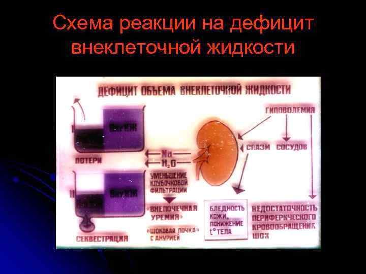 Схема реакции на дефицит внеклеточной жидкости 