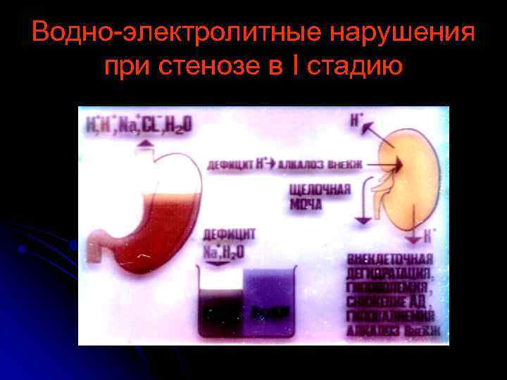 Водно-электролитные нарушения при стенозе в I стадию 