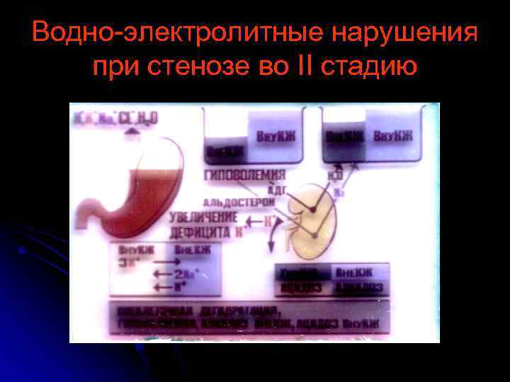 Водно-электролитные нарушения при стенозе во II стадию 