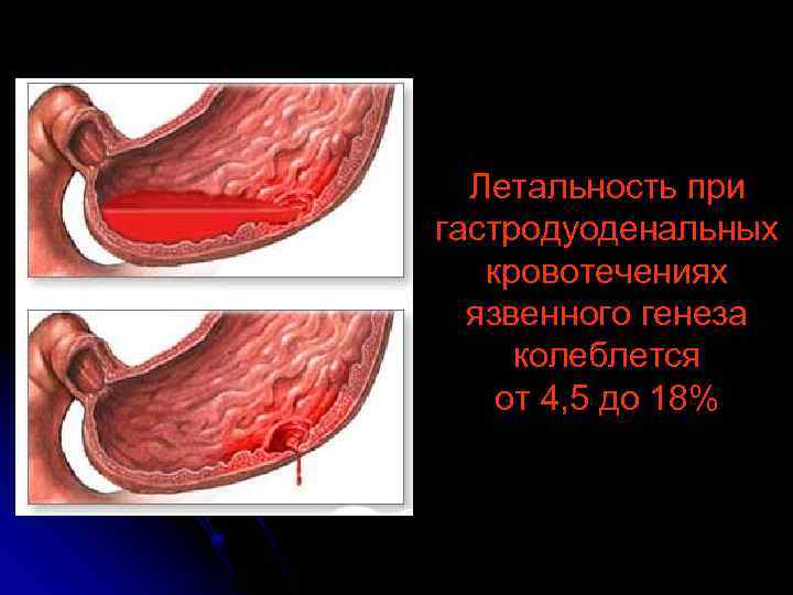 Летальность при гастродуоденальных кровотечениях язвенного генеза колеблется от 4, 5 до 18% 