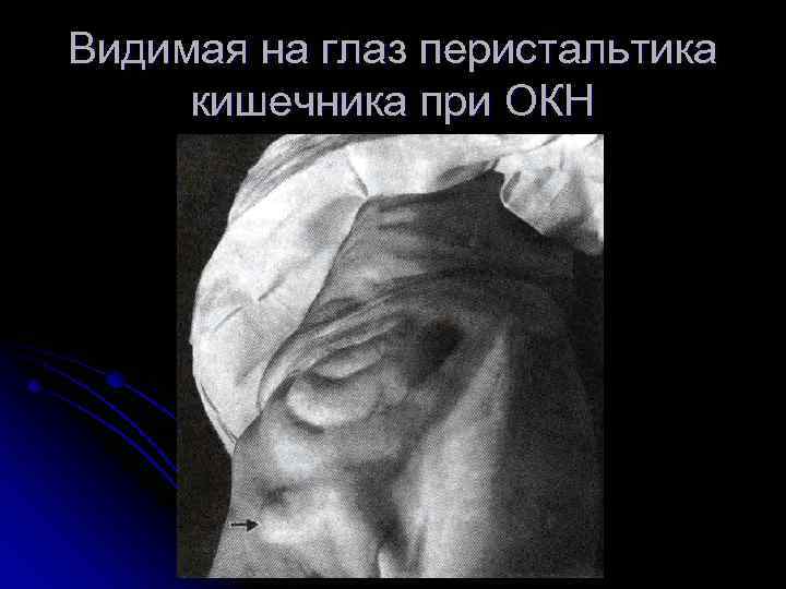 Видимая на глаз перистальтика кишечника при ОКН 