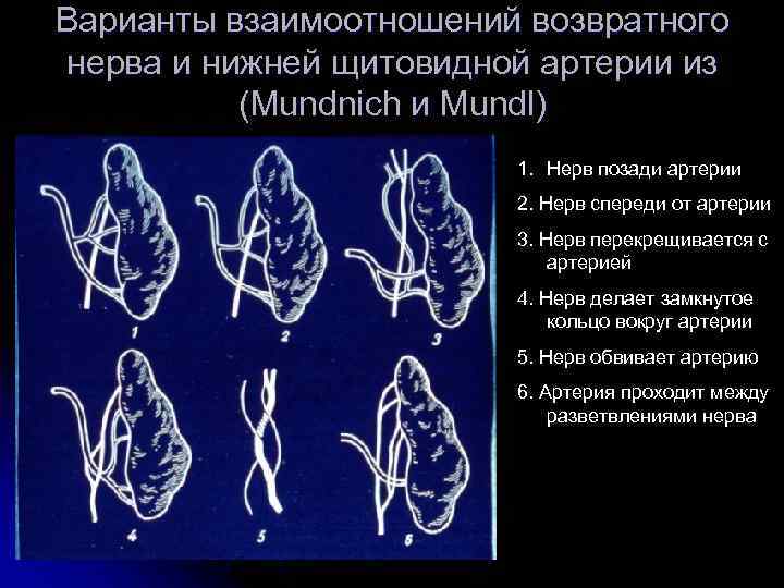 Варианты взаимоотношений возвратного нерва и нижней щитовидной артерии из (Mundnich и Mundl) 1. Нерв