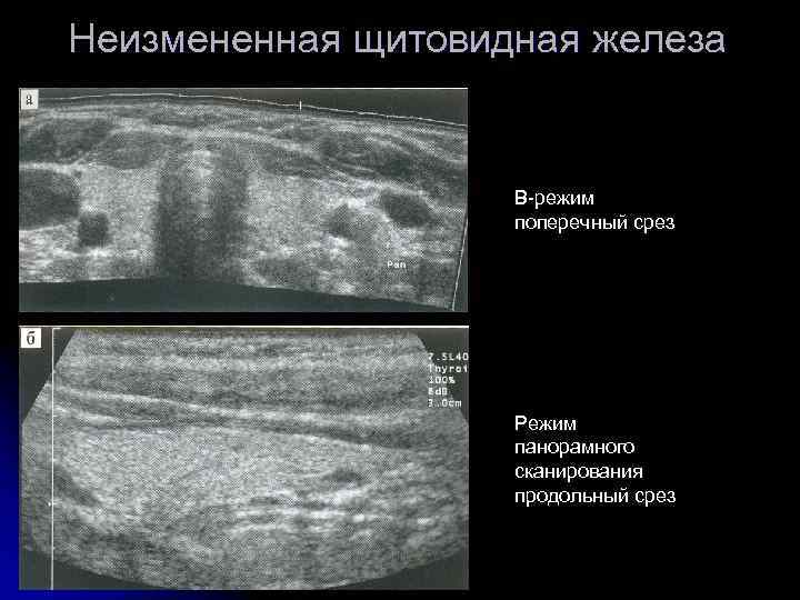 Неизмененная щитовидная железа В-режим поперечный срез Режим панорамного сканирования продольный срез 