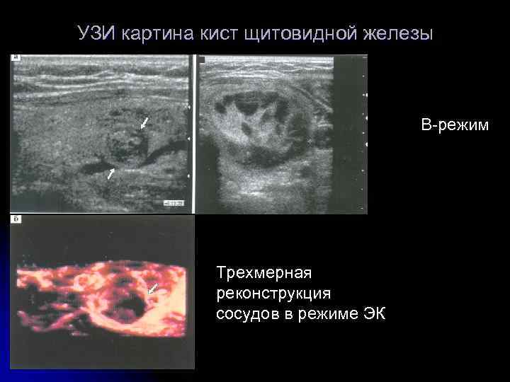 УЗИ картина кист щитовидной железы В-режим Трехмерная реконструкция сосудов в режиме ЭК 