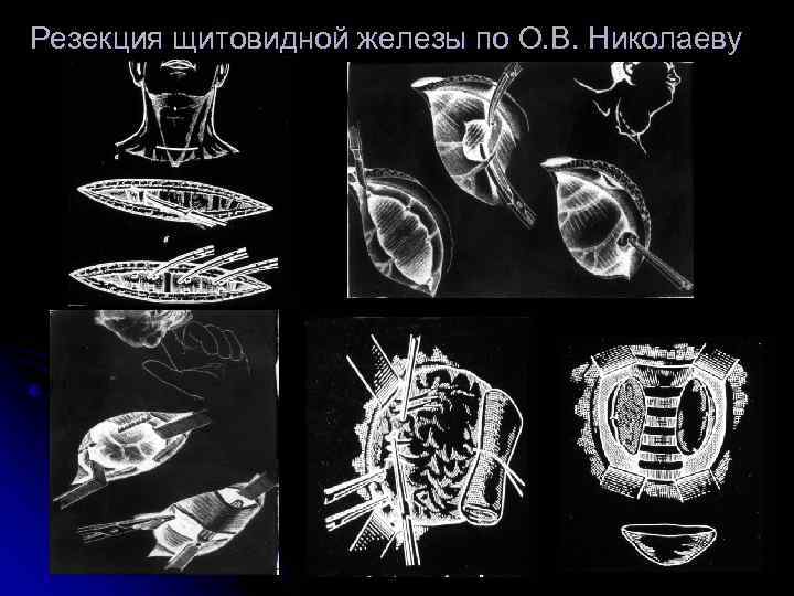 Резекция щитовидной железы по О. В. Николаеву 