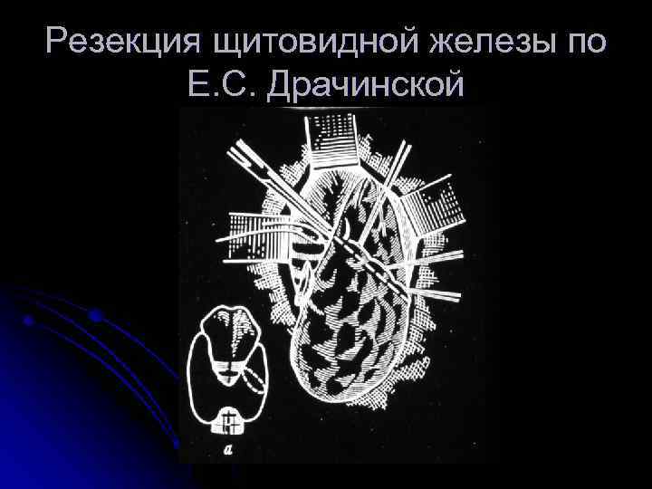 Резекция щитовидной железы по Е. С. Драчинской 