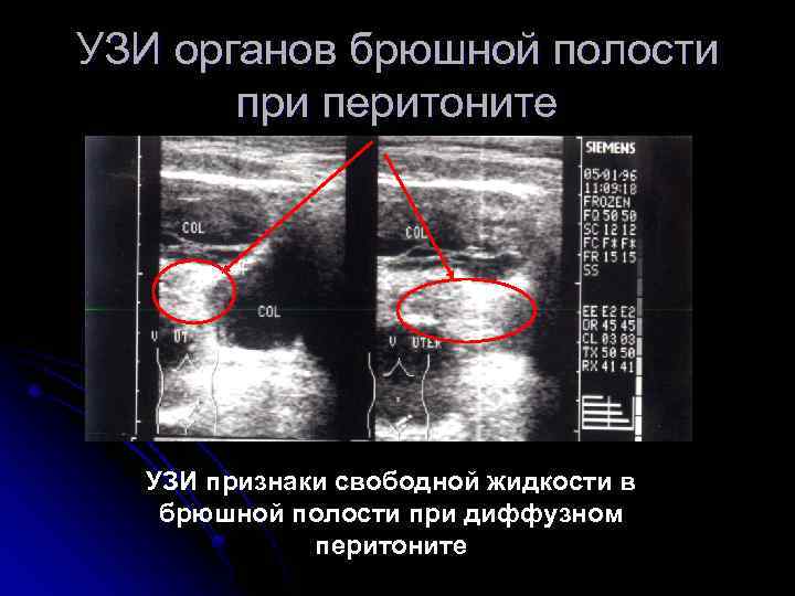 УЗИ органов брюшной полости при перитоните УЗИ признаки свободной жидкости в брюшной полости при