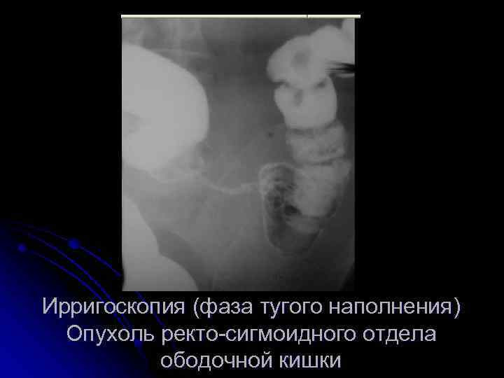 Ирригоскопия (фаза тугого наполнения) Опухоль ректо-сигмоидного отдела ободочной кишки 