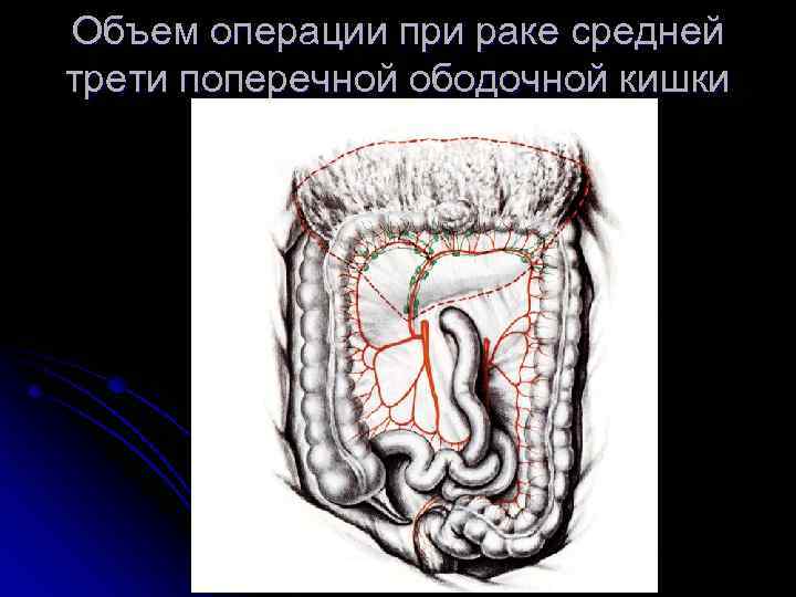 Объем операции при раке средней трети поперечной ободочной кишки 