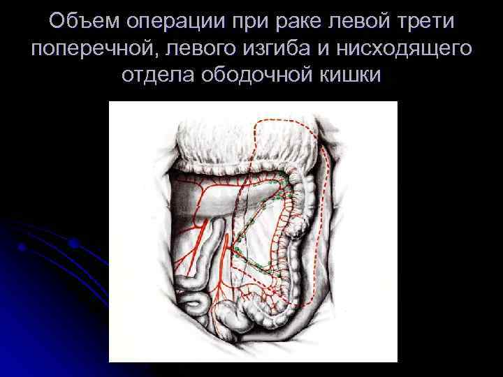 Объем операции при раке левой трети поперечной, левого изгиба и нисходящего отдела ободочной кишки