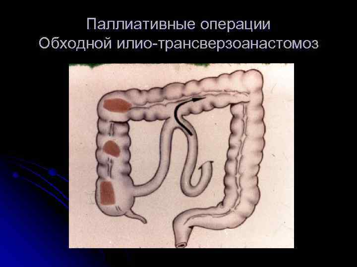 Паллиативные операции Обходной илио-трансверзоанастомоз 