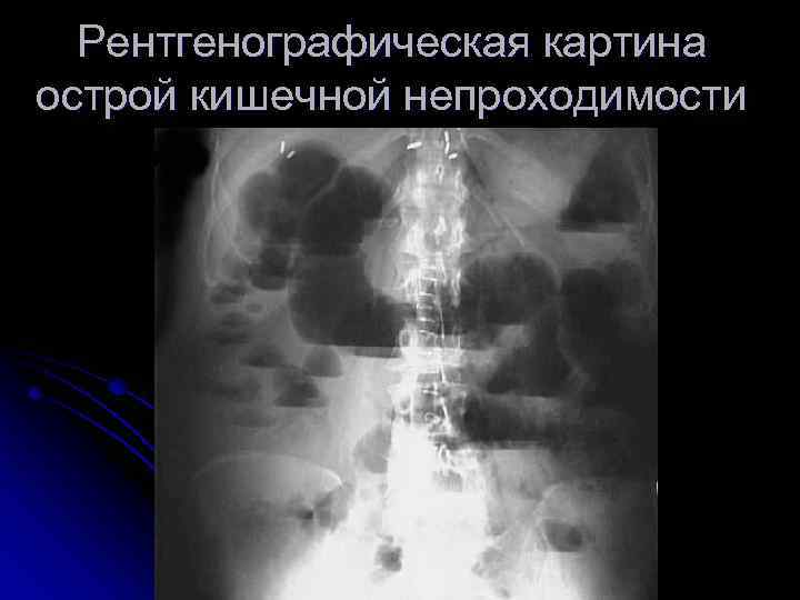Рентгенографическая картина острой кишечной непроходимости 