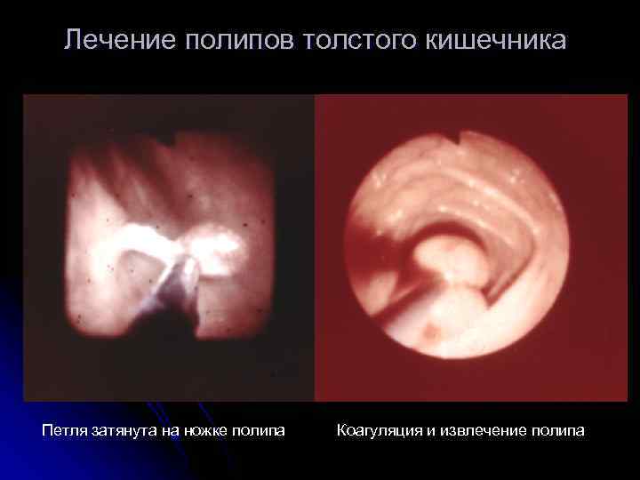 Лечение полипов толстого кишечника Петля затянута на ножке полипа Коагуляция и извлечение полипа 