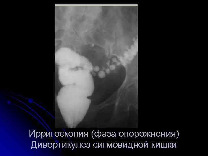 Ирригоскопия (фаза опорожнения) Дивертикулез сигмовидной кишки 