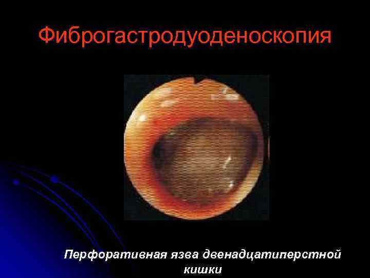 Фиброгастродуоденоскопия Перфоративная язва двенадцатиперстной кишки 
