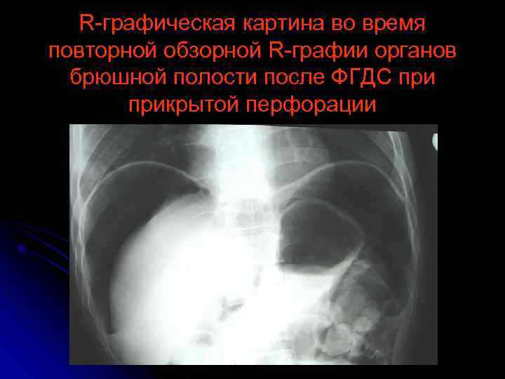 Язва на узи. Прободная язва желудка рентген. Перфорация язвы желудка рентгенограмма. УЗИ брюшной полости при перфорации язвы желудка. Перфорация (прободение) язвы.