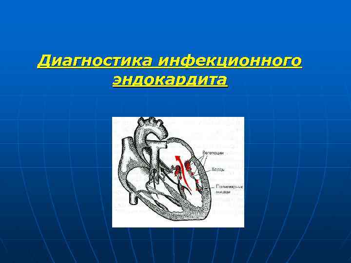 Диагностика инфекционного эндокардита 