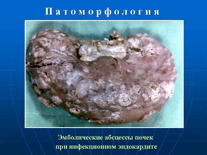 Патоморфология Эмболические абсцессы почек при инфекционном эндокардите 