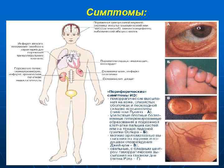 Симптомы: 