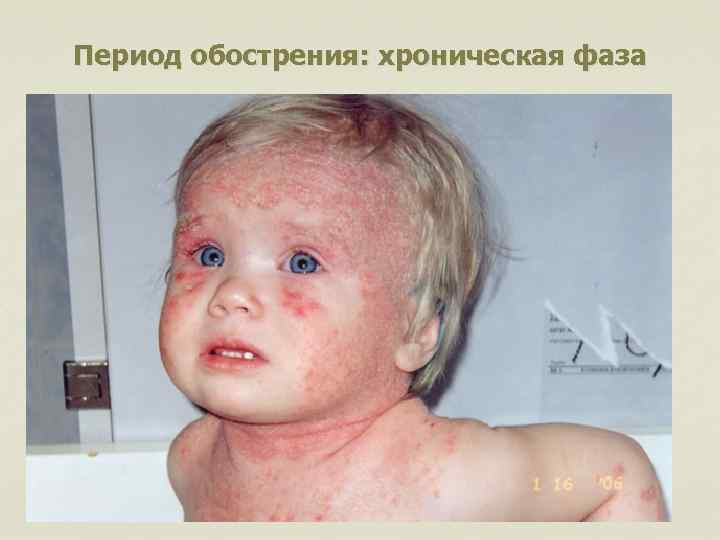 Период обострения: хроническая фаза 