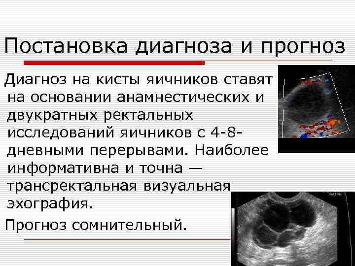 Постановка диагноза и прогноз Диагноз на кисты яичников ставят на основании анамнестических и двукратных