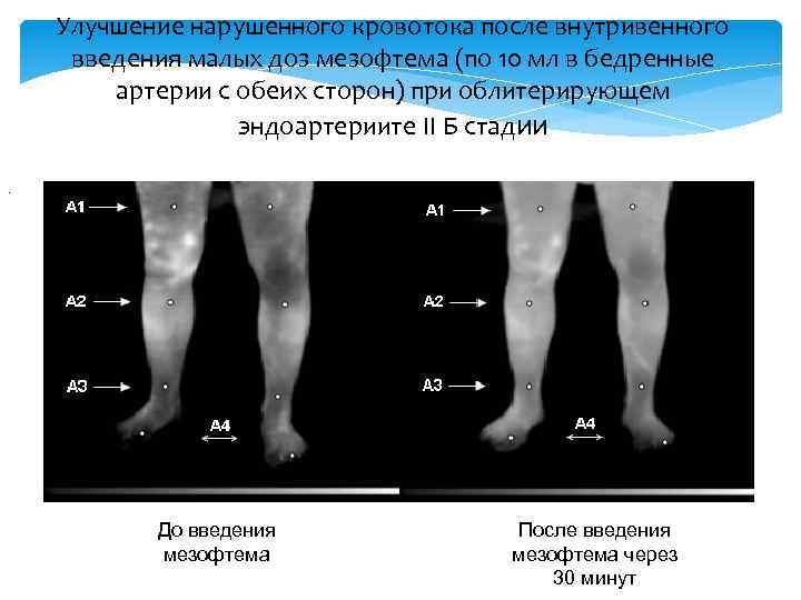Улучшение нарушенного кровотока после внутривенного введения малых доз мезофтема (по 10 мл в бедренные