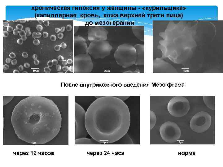 хроническая гипоксия у женщины - «курильщика» (капиллярная кровь, кожа верхней трети лица) до мезотерапии