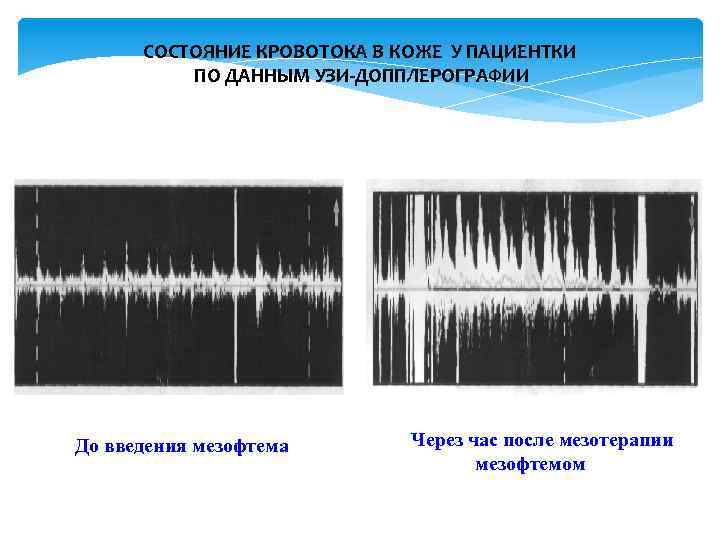 СОСТОЯНИЕ КРОВОТОКА В КОЖЕ У ПАЦИЕНТКИ ПО ДАННЫМ УЗИ-ДОППЛЕРОГРАФИИ До введения мезофтема Через час