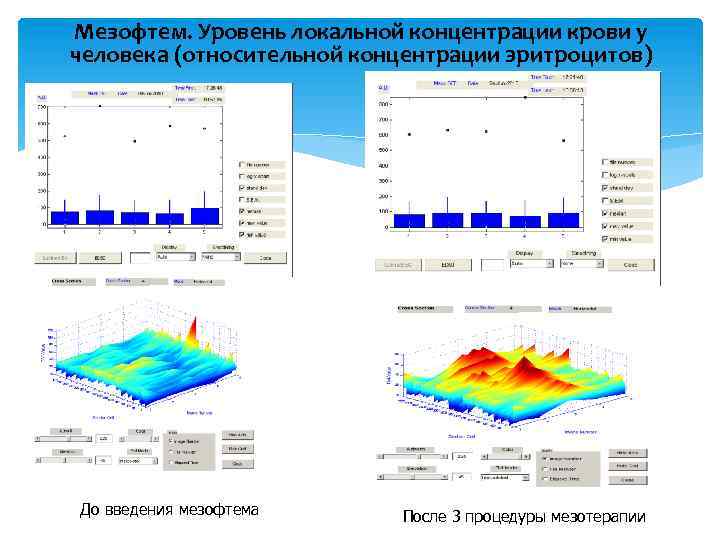 Мезофтем. Уровень локальной концентрации крови у человека (относительной концентрации эритроцитов) До введения мезофтема После