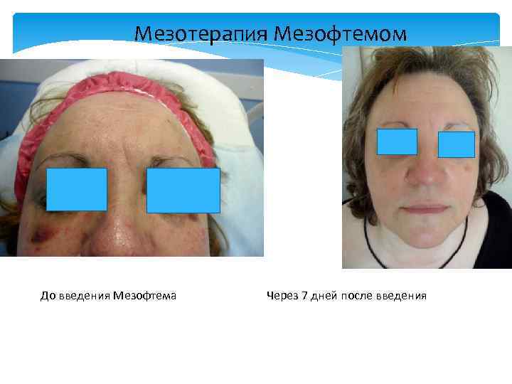 Мезотерапия Мезофтемом До введения Мезофтема Через 7 дней после введения 